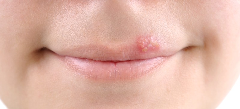 Natural Cold Sore Treatments