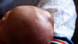 Can Birth Injuries Cause Caput Succedaneum?